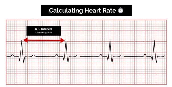 What Is Use of ECG Test Report