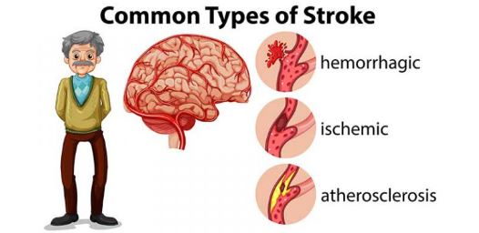 Brain Stroke